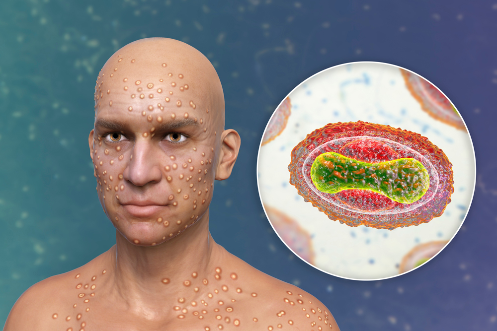 Smallpox Variola Major Bertin Environics
